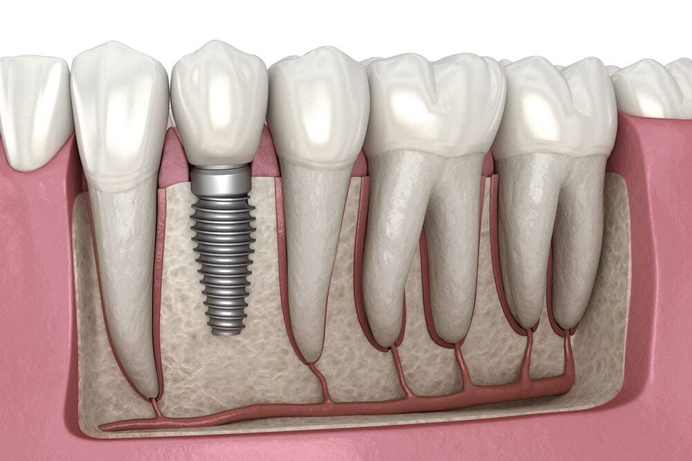 implant dentar uai